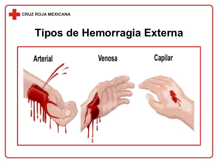 Prevención de riesgos escolares y primeros auxilios. Hemorragia Prevención de riesgos escolares y primeros auxilios. Hemorragia