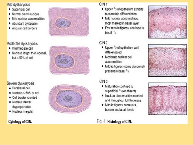 Signs of hpv or cervical most cancers cervical most cancers spread to lungs survival rate