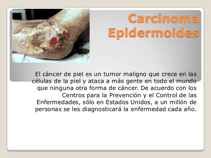 carcinoma epidermoide infiltrante de piel pdf