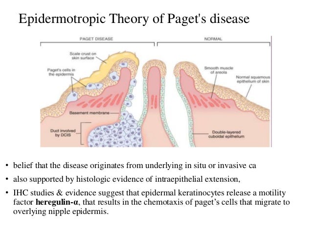 pagets disease of the breast pictures 56272 pagets disease of the breast pictures 56271