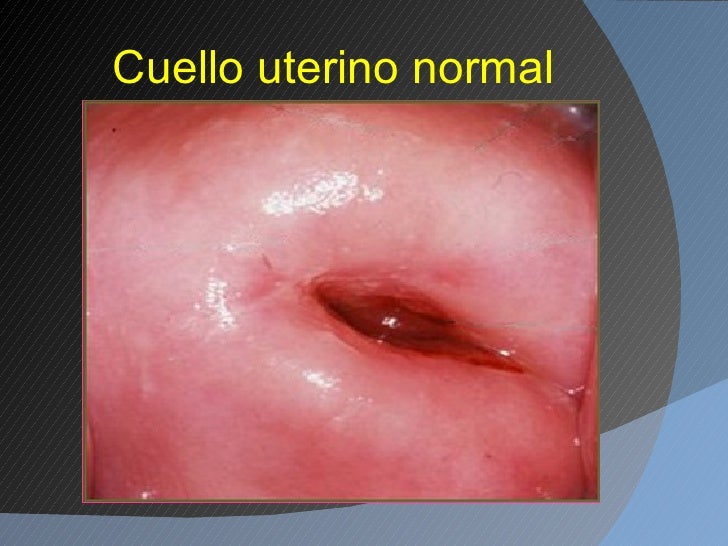 Most cancers cervical ppt surviving cervical most cancers