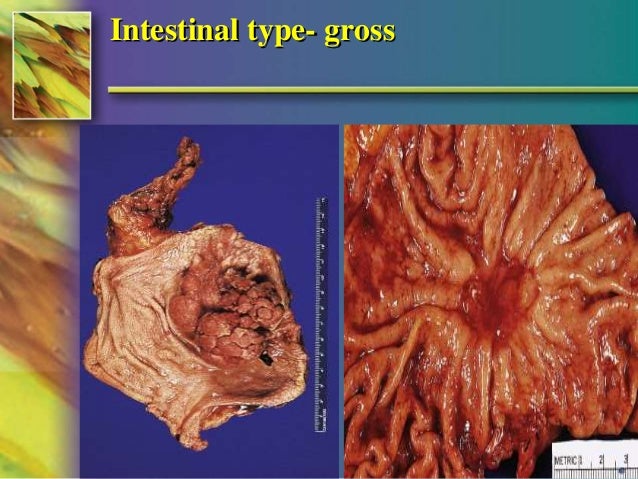Diffuse Vs Intestinal Gastric Cancer Usmle