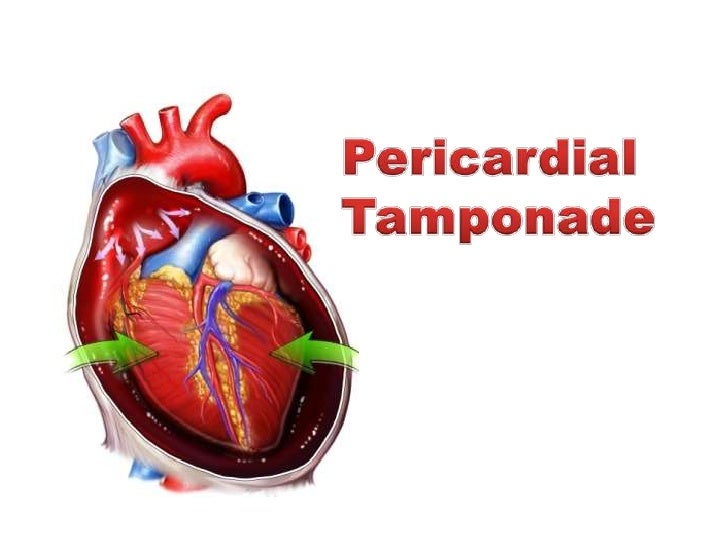 Pericardial Tamponade