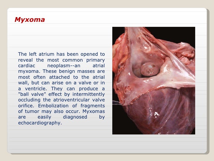 cardiac tumors 25% of cardiac tumors are complicated by tumor embolization- what location of tumor conveys highest risk - age-location - histological origin - noninvasive tissue characterization what 4 factors can help to determine the etiology of a primary cardiac tumor myxomas. cardiac tumors 25% of cardiac tumors are complicated by tumor embolization- what location of tumor conveys highest risk - age-location - histological origin - noninvasive tissue characterization what 4 factors can help to determine the etiology of a primary cardiac tumor myxomas.