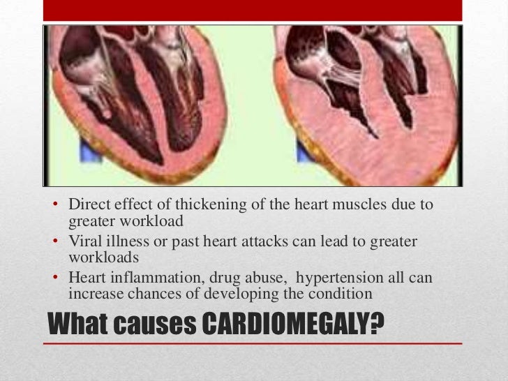 Cardiomegaly Cardiomegaly