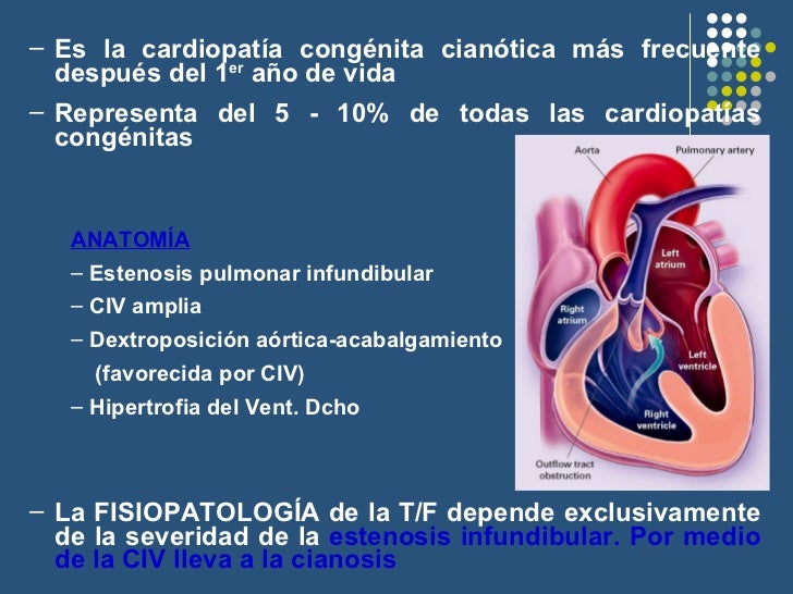 Cardiopatia Congenita Cianogena Mas Frecuente