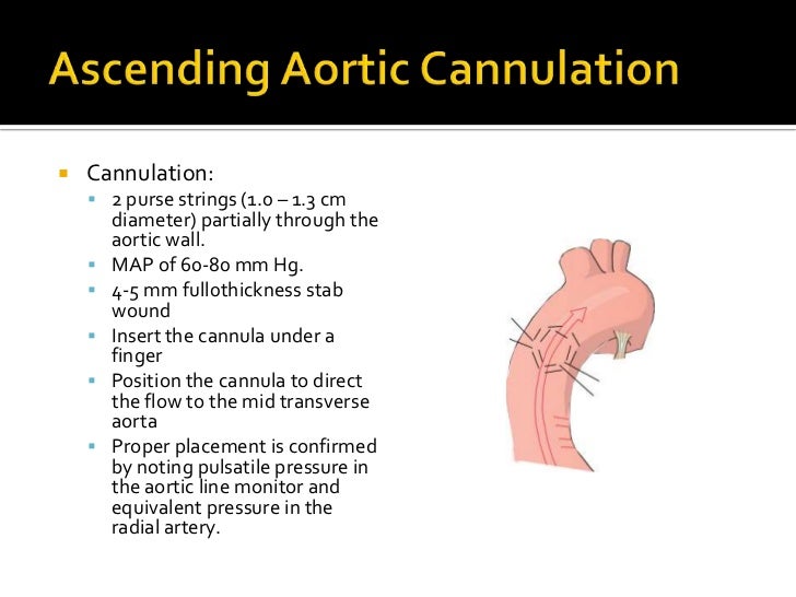 Cardiopulmonary bypass