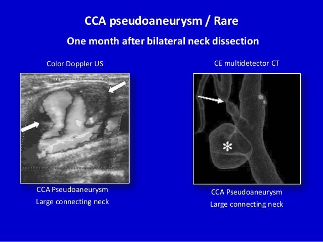 carotid doppler radiology carotid doppler radiology