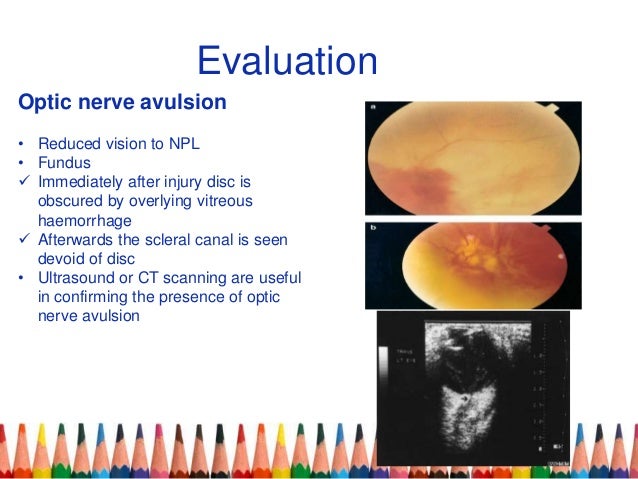 traumatic optic neuropathy