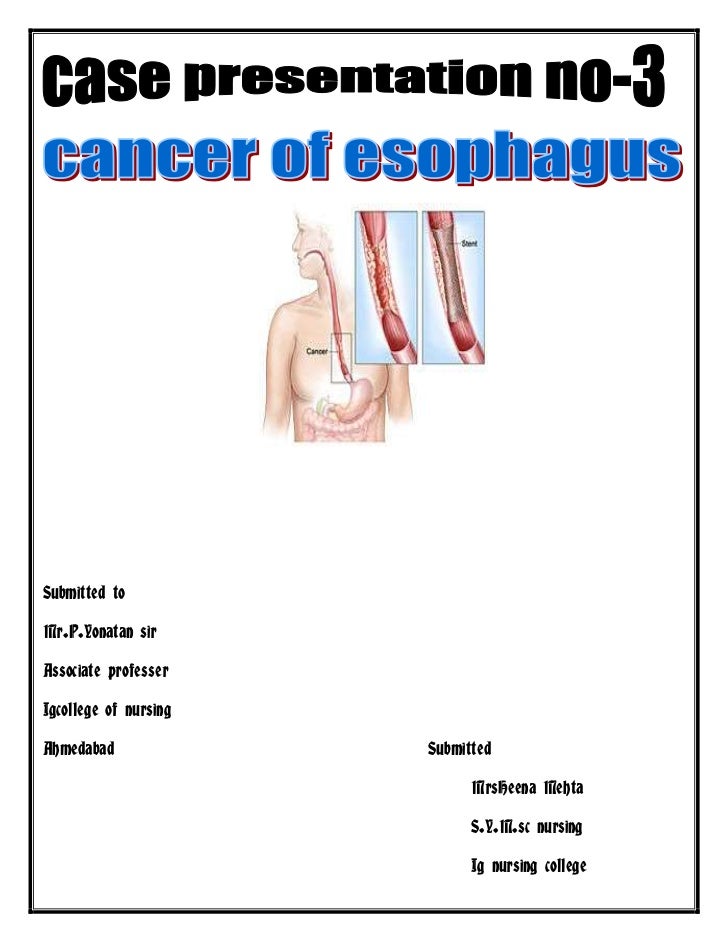 Esophageal Cancer Case Study
