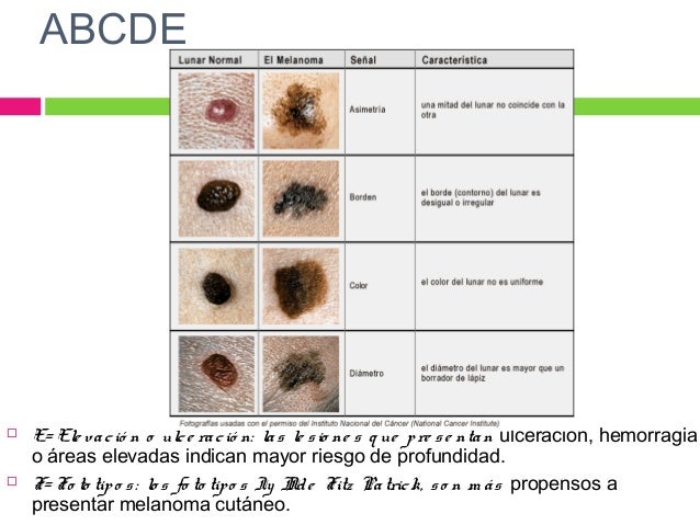 melanoma case melanoma case