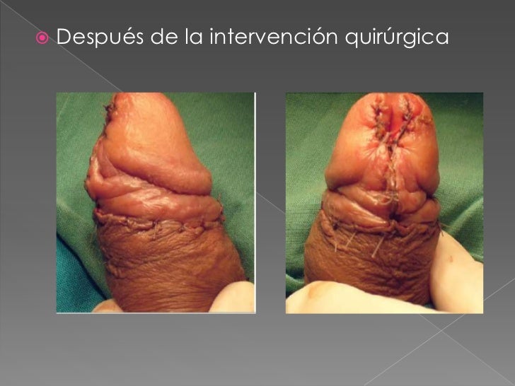 Que hacer si a ti el pequeño miembro