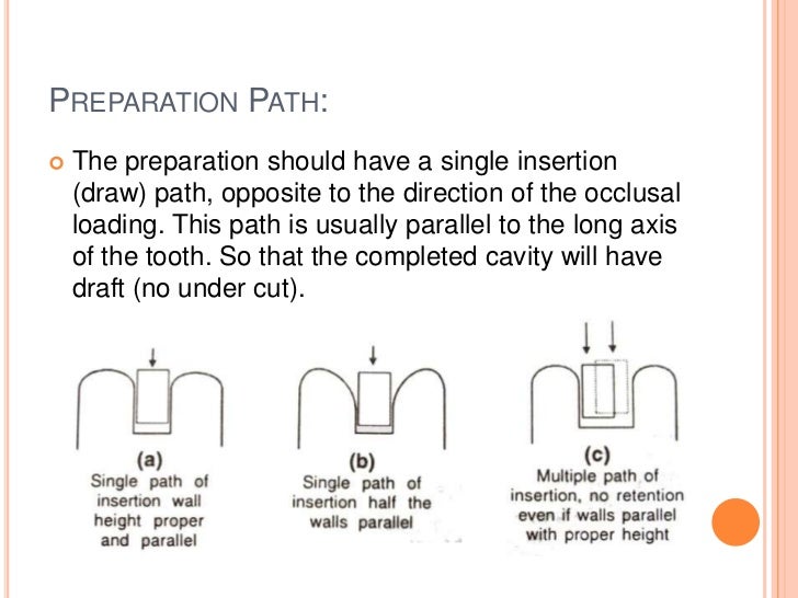 Cast gold Inlay restorations