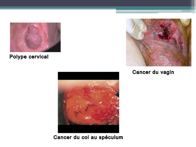 Cancer Endomètre Tamoxifène