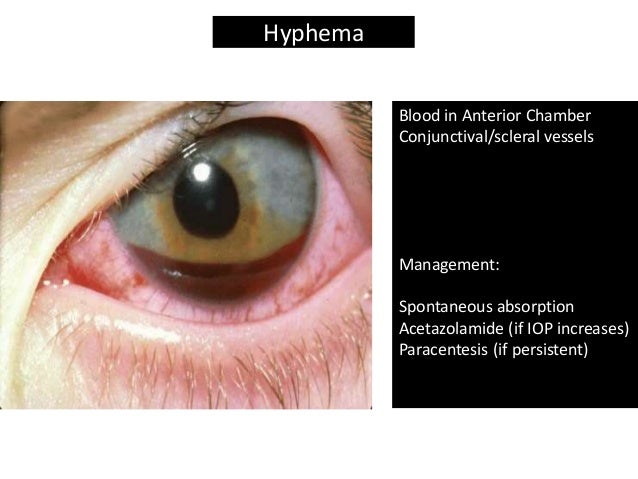 Cataract Surgery Complications for General Practitioners
