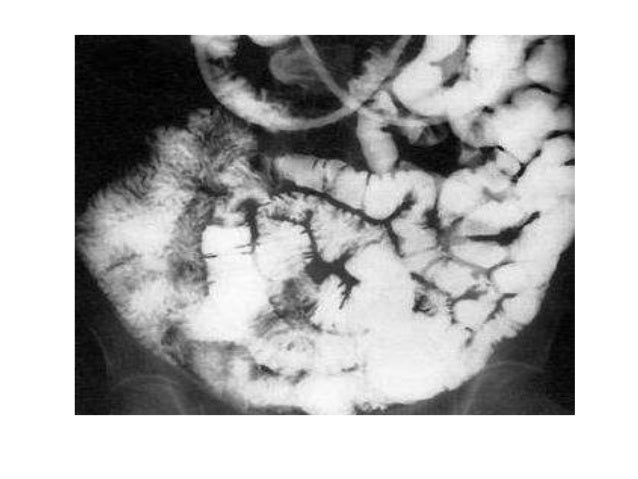 Most cancers Du Pancréas Douleurs Abdominales