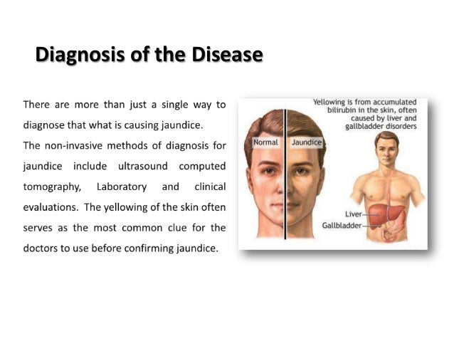 Jaundice: Symptoms Treatment Jaundice: Symptoms Treatment