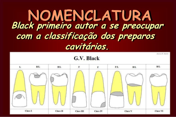 Nomenclatura E Classifica o De Cavidades nomenclatura-e-classifica-o-de-cavidades