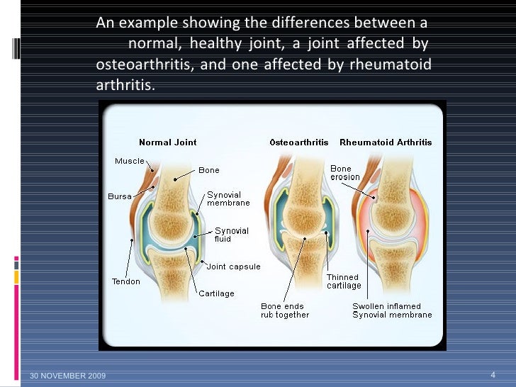 rheumatoid arthritis thesis Rheumatoid arthritis name university abstract there have been many studies concerning the occurrence of rheumatoid arthritis. rheumatoid arthritis thesis Rheumatoid arthritis name university abstract there have been many studies concerning the occurrence of rheumatoid arthritis.