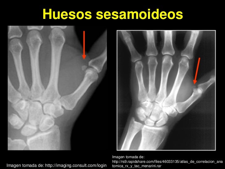 RADIOGRAFIA CARPAL