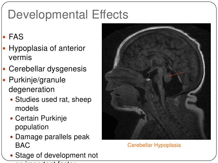 Cerebellum And Alcohol