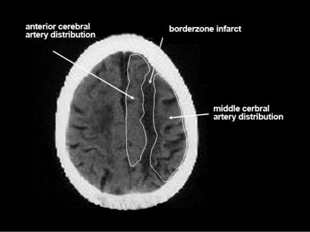 ischaemic stroke headaches commonplace symptoms and signs of stroke