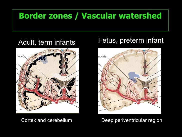 Cerebral Ischemia