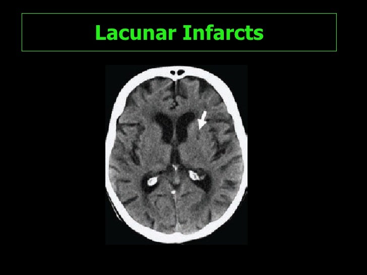 tia signs in teenagers stroke hazard evaluation atrial traumatic inflammation