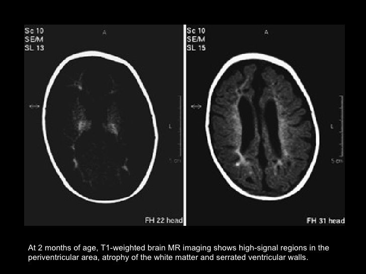Cerebral Ischemia