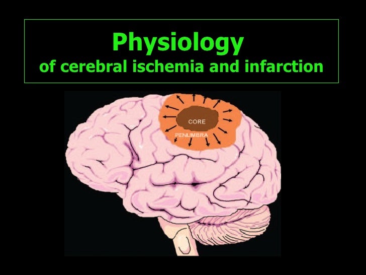 Cerebral Ischemia