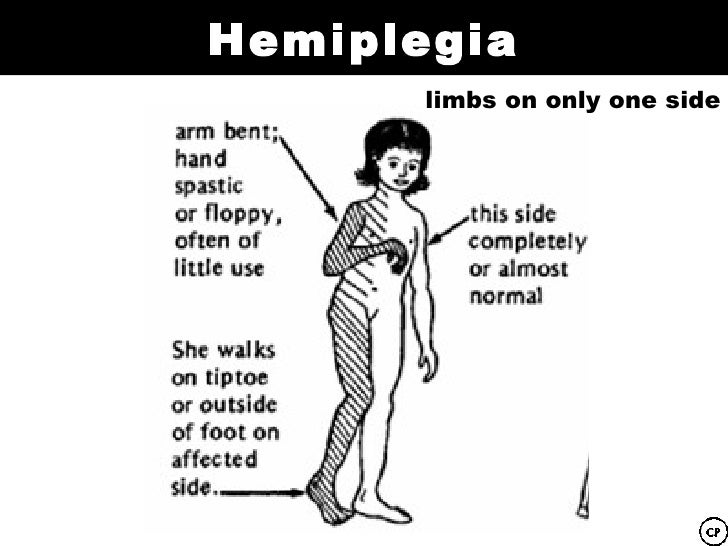 Palsy types in adults
