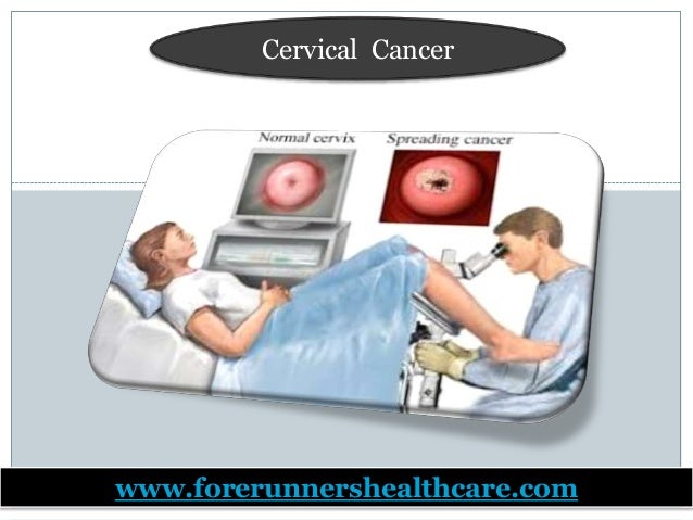 Most cancers Cervical Slideshare