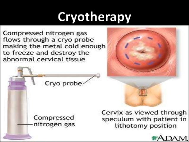 symptoms that cervical cancer has spread to different organs
