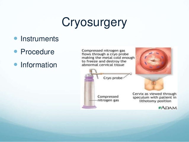 cancer de cervix y endometrio