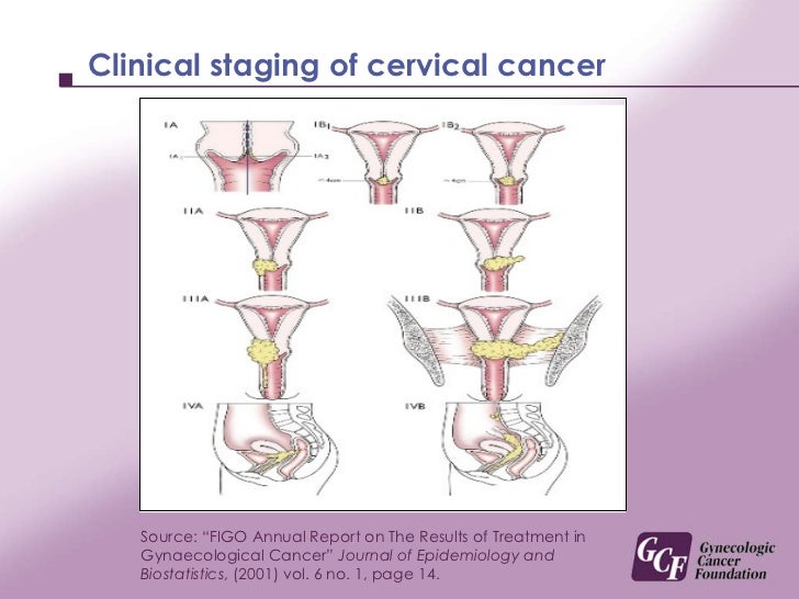 stages of cervical cancer The type of treatment used for cervical cancer depends on the stage at diagnosis standard treatment includes surgery, radiation, and chemotherapy. stages of cervical cancer The type of treatment used for cervical cancer depends on the stage at diagnosis standard treatment includes surgery, radiation, and chemotherapy.