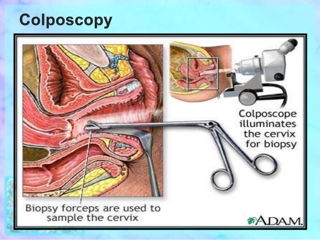 colorectal cancer can cervical cancer cause you to bleed