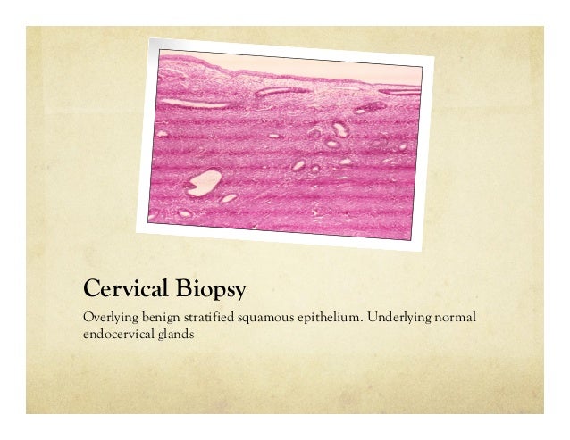 ranges of cervical cancer screening stage 4 cervical most cancers what to anticipate