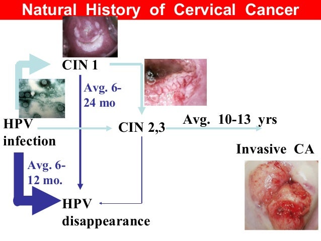 Natural History Of Cin Disease Progression Natural History Of Cin Disease Progression