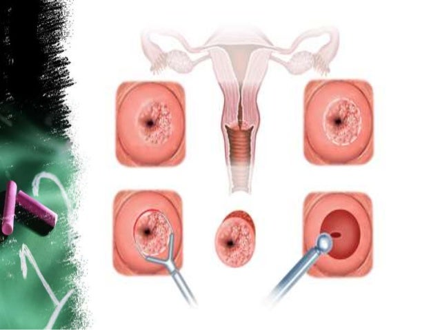 Cervical cancer Vaccine Age