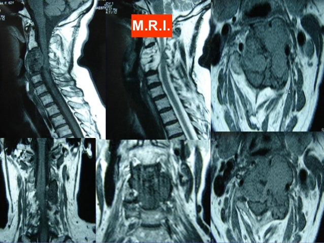 Cervical cancer Needle