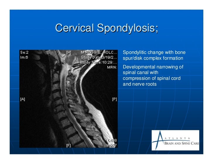 cervical spondylosis causes incidence and risk Cervical spondylosis is a form of arthritis that affects the neckit is caused by degeneration of the cervical spine or the bones in the neck it is more common in elderly people. cervical spondylosis causes incidence and risk Cervical spondylosis is a form of arthritis that affects the neckit is caused by degeneration of the cervical spine or the bones in the neck it is more common in elderly people.