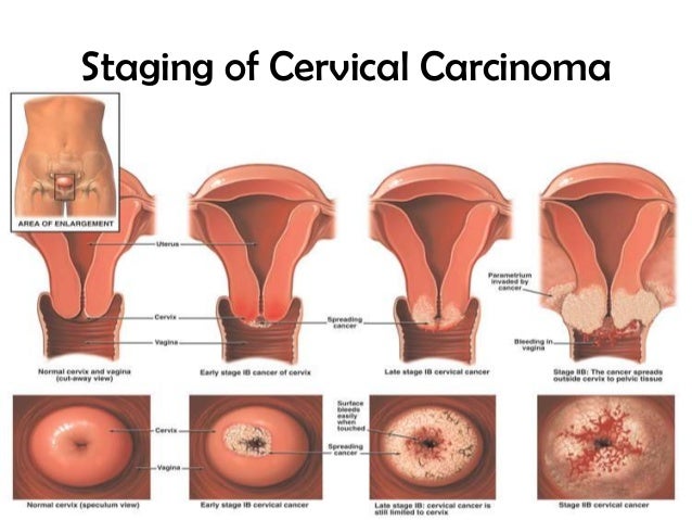 what happens if you have level four cervical cancer