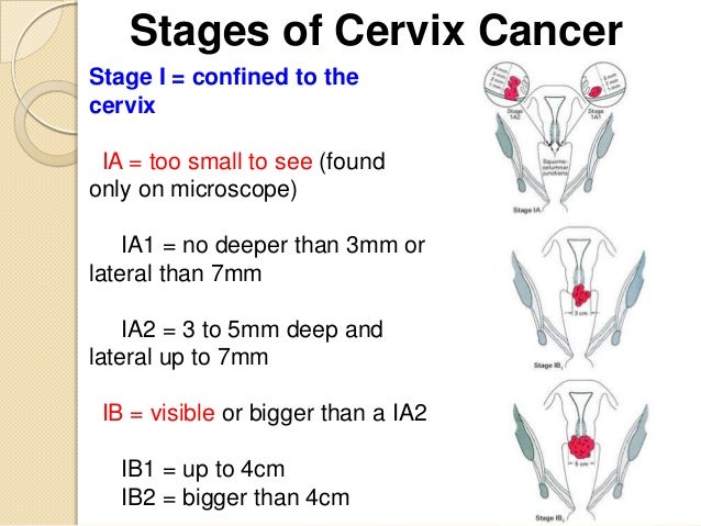 Cervical Cancer Levels 2