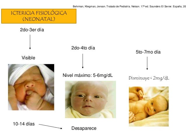 ICTERICIA NEONATAL ICTERICIA NEONATAL