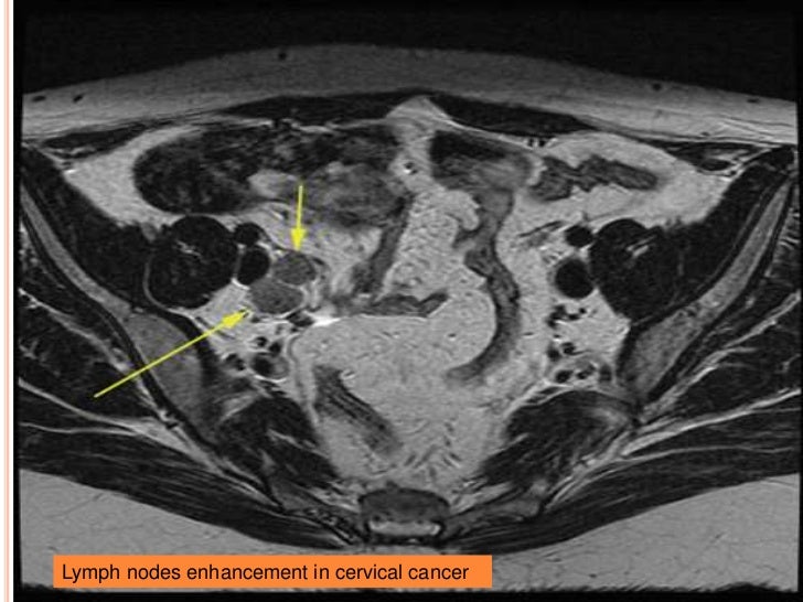 Signs and symptoms recurrent cervical cancer bad lymph nodes cervical zingers
