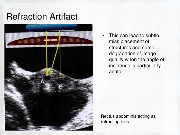 comet tail artifact meaning comet tail artifact meaning