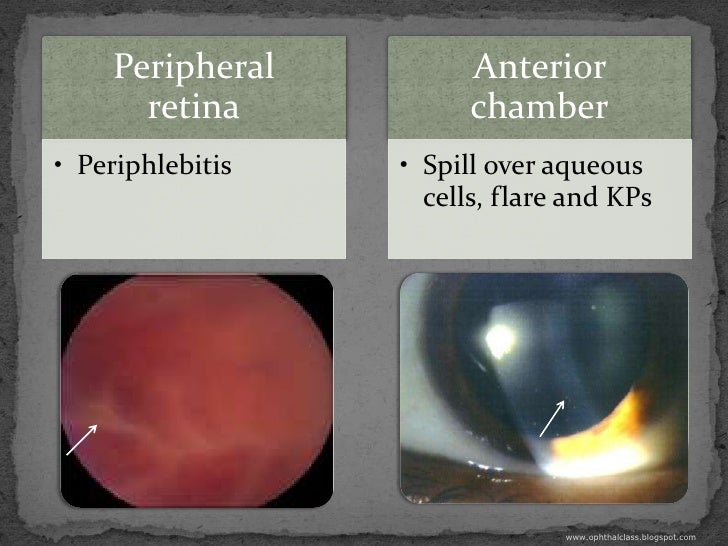 Overview of uveitis Part2 Clinical features