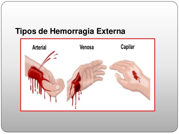HEMORRAGIA TRATAMIENTO hemorragia tratamiento: