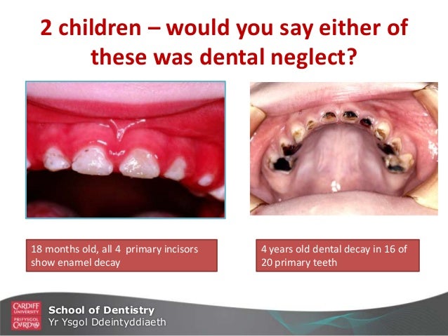 Diet and Dental Caries in Children pics Diet and Dental Caries in Children photo
