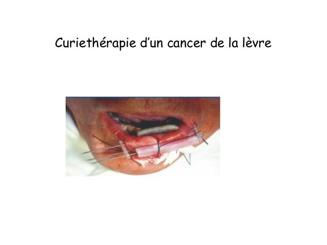 gonflement après radiothérapie